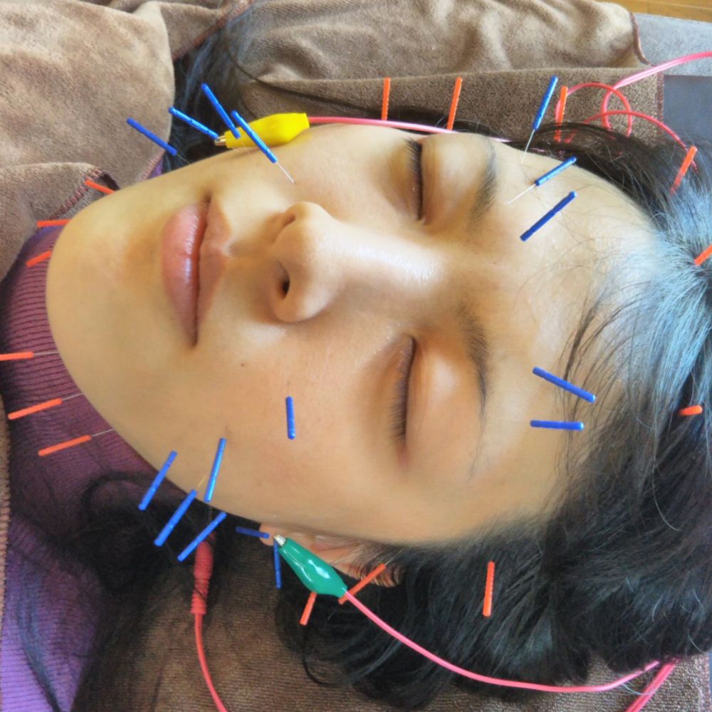 美容鍼の様子